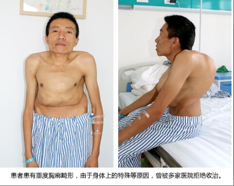 胸廓畸形结石患者的艰难
